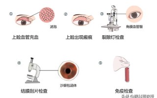 怎么判断得了沙眼？医生说有这几个方法